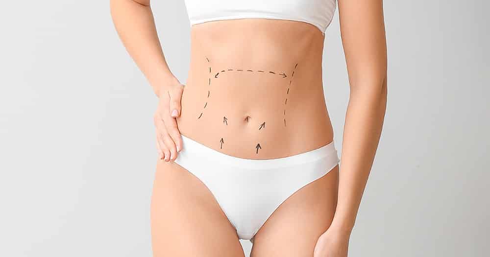 abdominoplastia